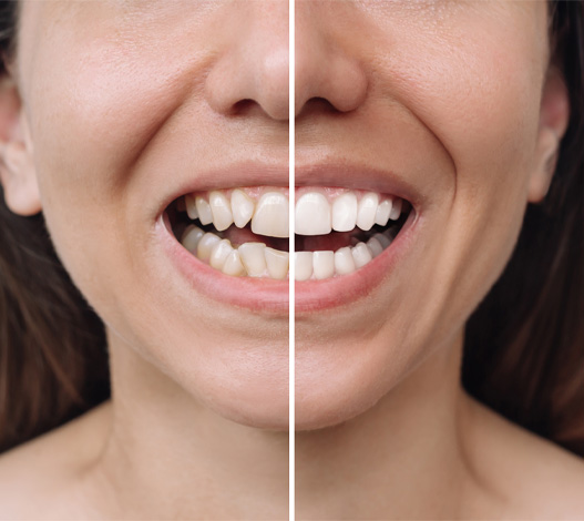 mouth reconstruction before after