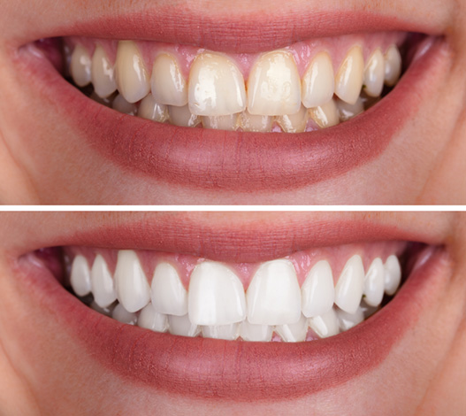 womans teeth before and after whitening