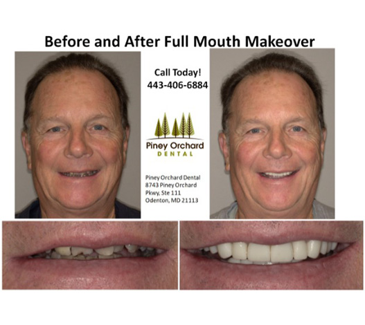 before and after full mouth makeover